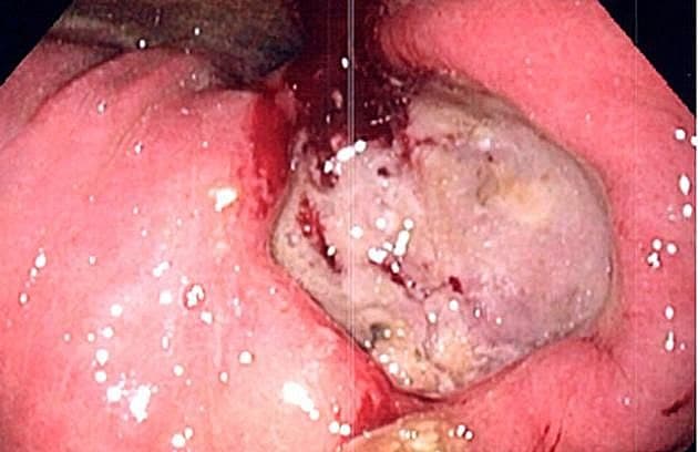 Fibrinbelagt ulcus ventriculi med randblødning.