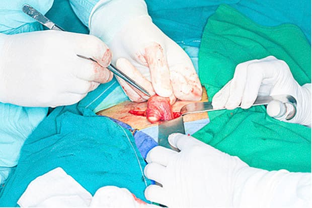 Åben operation for ingvinalhernie, hvor funiklen er blevet fridissekeret. Billedet er ikke fra sygehistorien.
