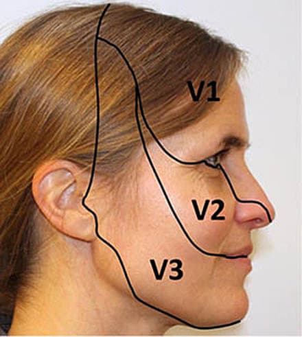 Innervationsområdet for de tre grene fra trigeminusnerven, n. opthalmicus (V1), n. maxillaris (V2) og n. mandibularis (V3). Trigeminusneuralgi rammer hyppigst kvinder og involverer oftest V2 og/eller V3. Modelfoto. Trykt med tilladelse.
