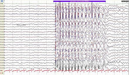 Klassisk spike-wave-paroksysme.
