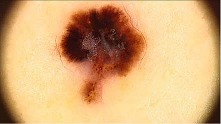 Malignt melanom. (Foto: Georg Authried, Dermatologisk Afdeling, Odense Universitetshospital).