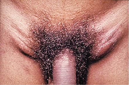 Bubodannelse ved lymphogranuloma venereum er hos ca. to tredjedele af patienterne unilateral, men hos en tredjedel af tilfældene ses bilateral affektion. (Fra http://cnx.org/content/m14883/latest/, CC BY 2.0).