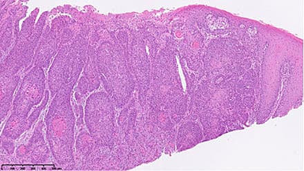 Hæmatoxylin-eosin-farvet snit fra biopsi i analkanalen. Helt til højre ses normalt pladeepitel, mens den resterende del er domineret af et keratiniserende planocellulært karcinom.