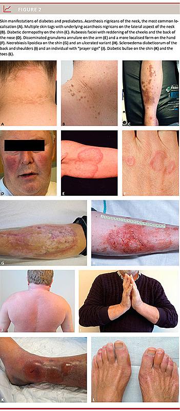 semester hvede kromatisk Specific skin signs as a cutaneous marker of diabetes mellitus and the  prediabetic state – a systematic review | Ugeskriftet.dk