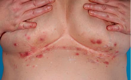 Aktiv hidrosadenitis suppurativa
under mammae.