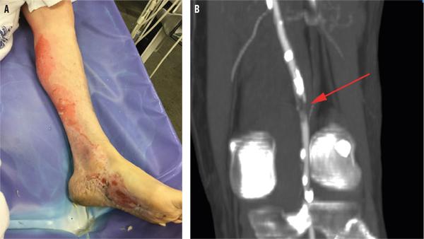 A. Klinisk præsentation af keraunoparalyse med en kold, bleg fod uden kapillær­respons. B. CT-angiografi med markering af nærokklusion af a. poplitea (pil).