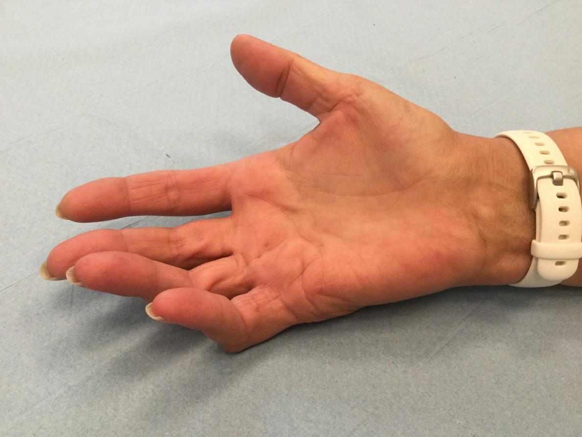 Clinical presentation of a patient with Dupuytren’s contracture in the fourth and fifth digits.