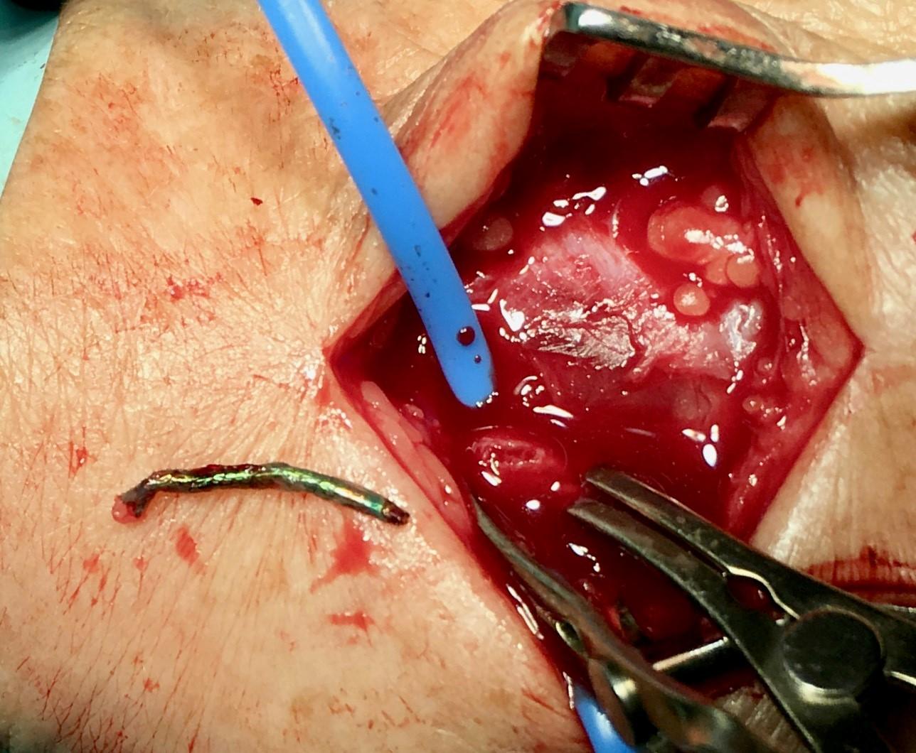 Den fjernede stent under operationen i venstre hånd.