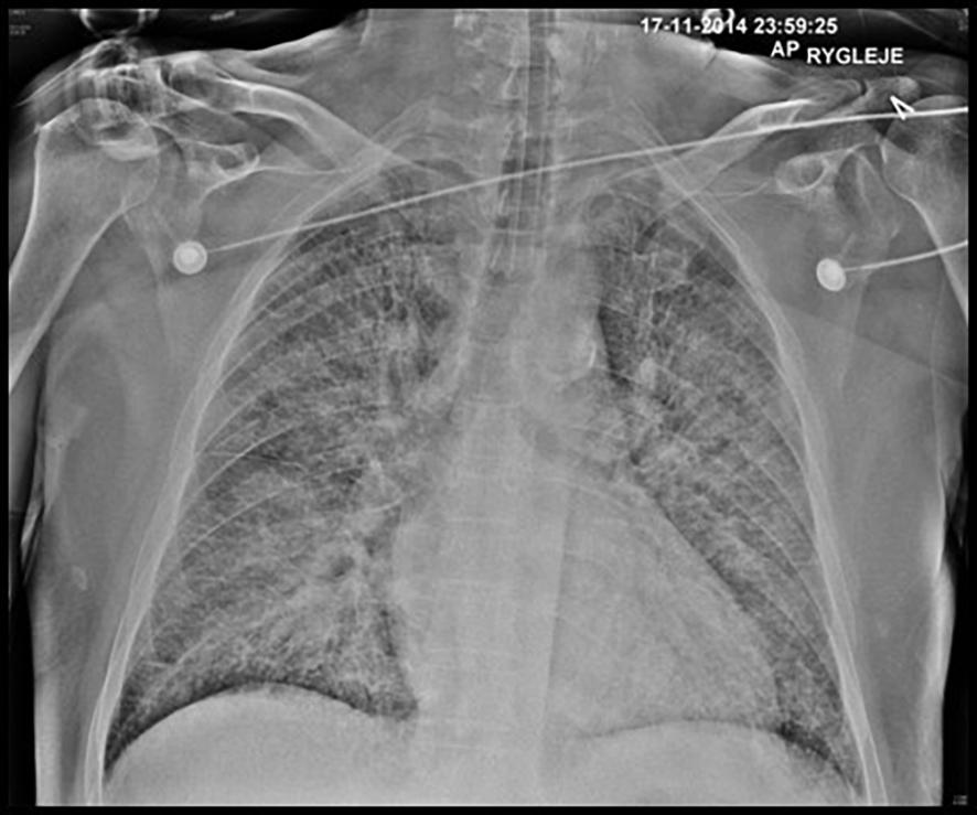 Eksempel på lungeødem. Røntgenbilledet af thorax er taget anterior-posteriort med patienten i rygleje, hvilket næsten altid er tilfældet, da patienter med akut hjertesvigt sjældent kan medvirke til stående optagelser.