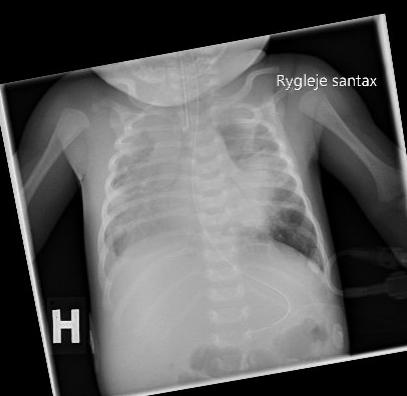 Røntgenbillede af thorax taget et døgn inden udskiftnings­transfusion. Der ses infiltrative og atelektatiske forandringer i begge lunger samt små væskeansamlinger i begge pleurae.