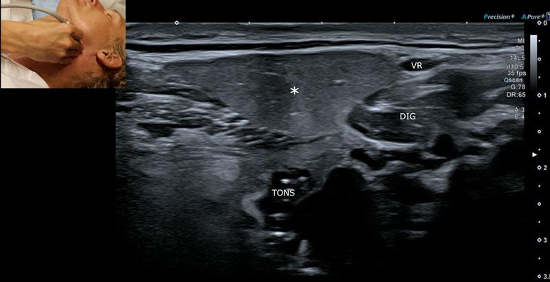 Skanning af gl. submandibularis (*) med tonsilla palatina (TONS) posterier herfor og m. digasticus venter posterior (DIG) og v. retromandibularis (VR) lateralt.