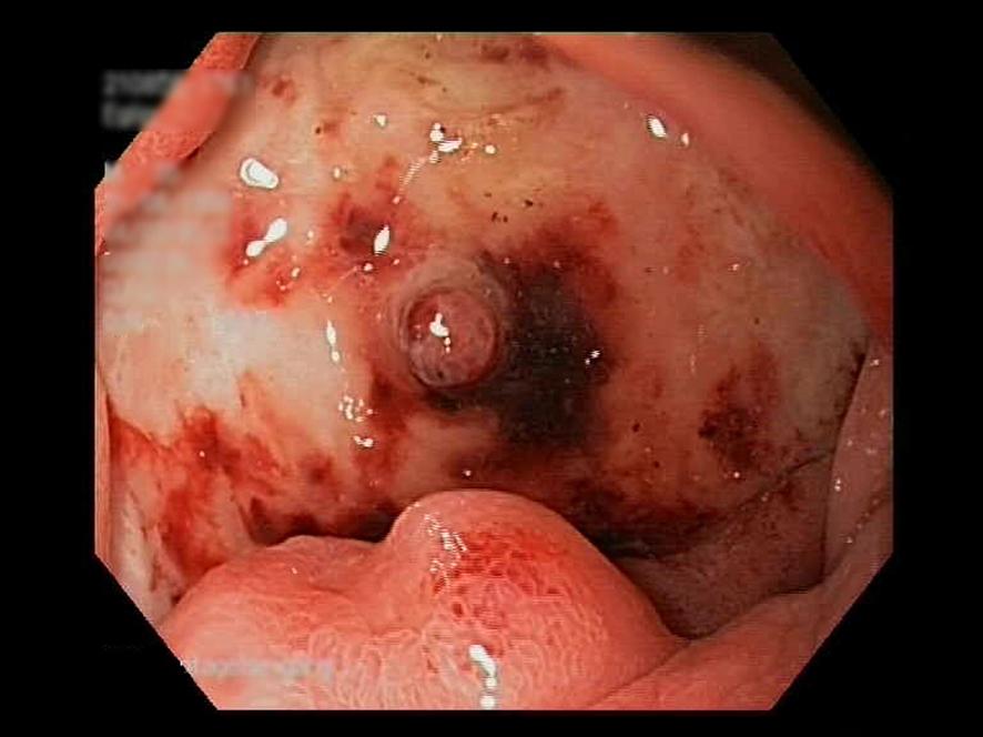 Blødning fra en større ulceration i bulbus duodeni med et centralt synlig kar uden aktiv blødning under endoskopien (Forrest IIa).