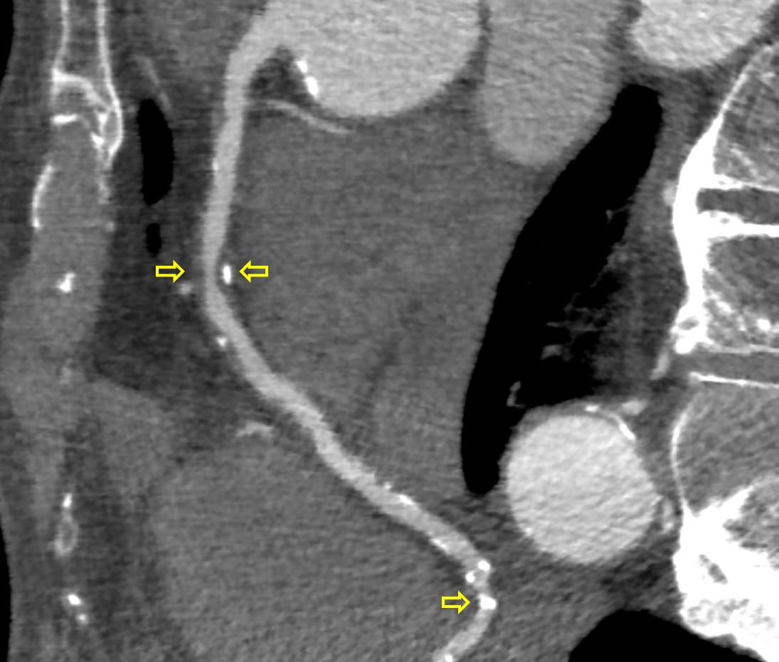 Den primære indikation for hjerte-CT er evaluering af koronare stenoser (mellem de øverste pile) forårsaget af åreforkalkning. Her ses både kalcificerede (hvide, nederste pil), ikkekalcificerede (mørke, venstre øverste pil) og blandede (højre venstre pil) plaques. Denne patient blev henvist direkte til invasiv koronarangiografi og blev revaskulariseret. 