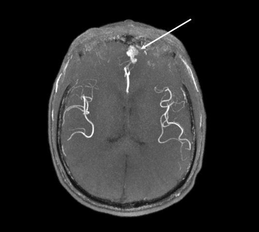 Asymptomatisk cerebral arteriovenøs malformation (pil) hos en 69-årig patient med hereditær hæmoragisk telangiektasi. Gengivet med tilladelse fra patienten.