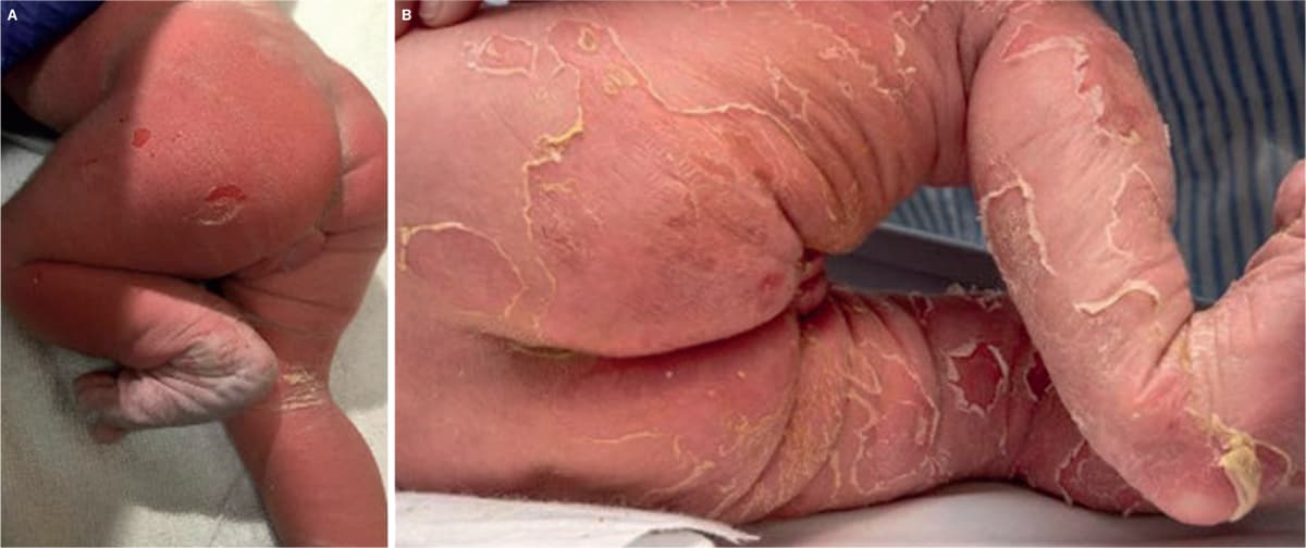 A. Dag 1. B. Dag 5. (Gengivet med forældres tilladelse)