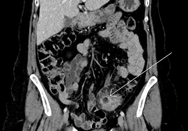 CT-billede af ukompliceret divertikulitis i colon sigmoideum med lokal inflammation og stranding omkring et divertikel (pil). 