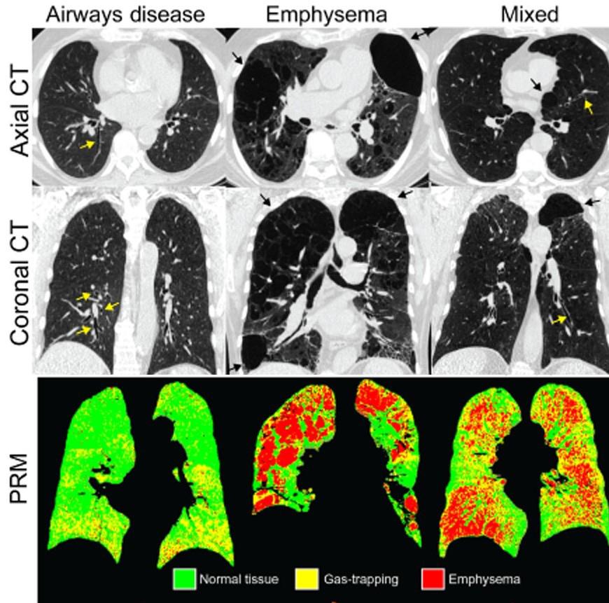 Aksiale og koronale CT-billeder samt parametric response maps af thorax. Fra venstre mod højre: primært luftvejssygdom, emfysem domineret og blandet fænotype. Gule pile indikerer luftvejssygdom og sorte pile indikerer emfysem.
