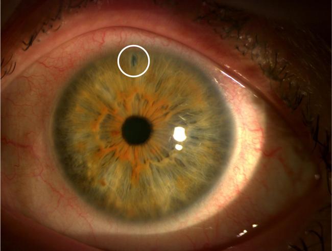 Foto af iridotomi. Iridotomi er et cirka 200 µm hul i iris. Hullet laves med laser, hvorved en eventuel trykdifference over iris elimineres.