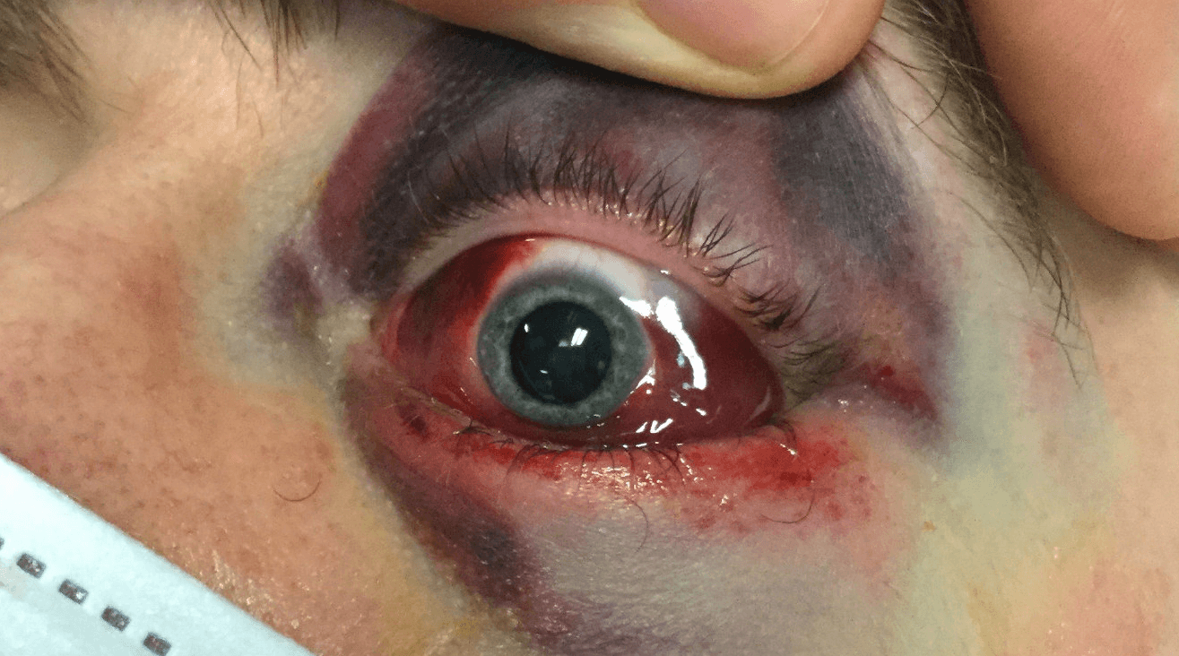 Venstre øje med periokulært ødem og misfarvning, subkonjunktivalt hæmatom, pupildilatation (efter indgift af tropicamidøjendråber) og exophthalmus.