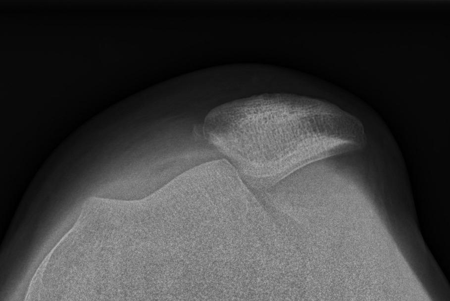 Tangentialoptagelse af et knæ med lateral patellaluksation.