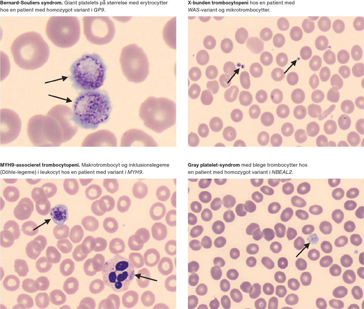Eksempler på perifere udstryg ved forskellige arvelige trombocytsygdomme.