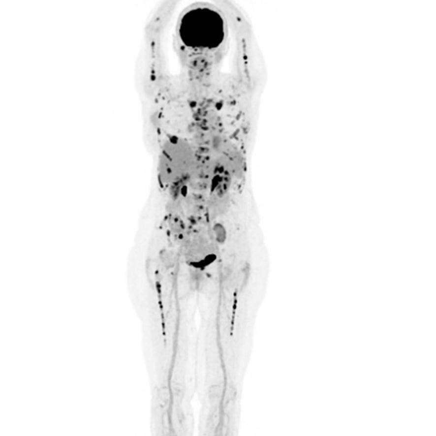 Karakteristisk præsentation af myelomatose ved 18F-fluoro­deoxy­glukose-PET. Den heterogene og multifokale distribution af sygdomsinfiltration knoglemarv og skelet er typisk hos nogle patienter; bemærk den rammende engelske betegnelse multiple myeloma. 
