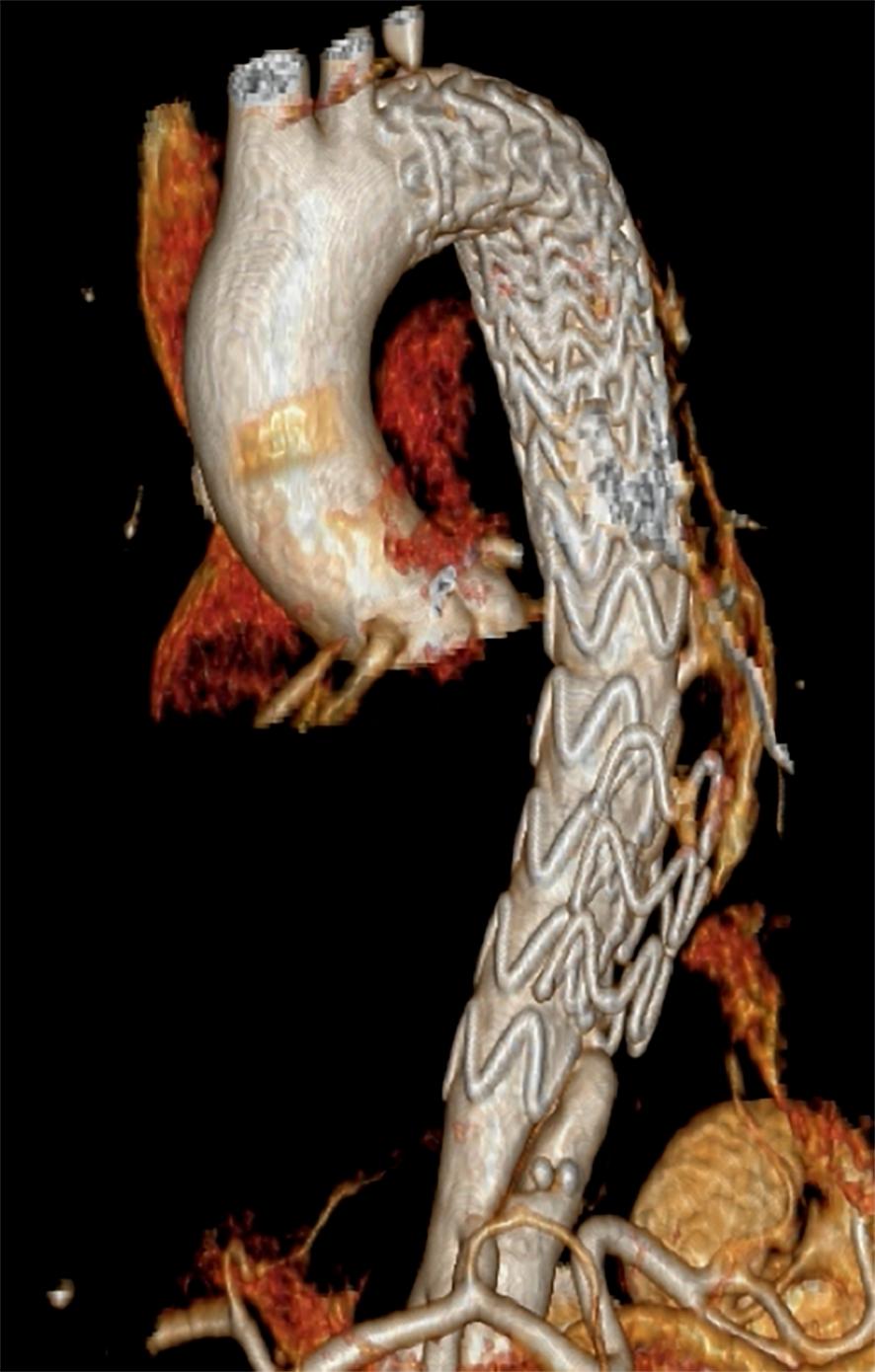 CT-rekonstruktion af aorta med type B-dissektion behandlet med thoracic endovascular aortic repair (TEVAR) fra afgangen af a. subclavia sinister til kranielt for truncus coeliacus.
