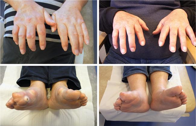 Fire billeder af den samme patient. På billederne til venstre ses hænder og fødder efter 20 år med ubehandlet arthritis urica. På billederne til højre ses hænder og fødder efter fire års behandling med allopurinol. Billederne gengives med patientens tilladelse.