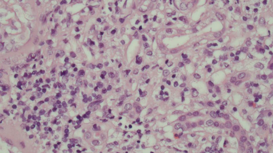 Lysmikroskopi af hæmatoxylin-eosin-farvet nyrebiopsi. Der ses interstitiel inflammation med rigelig infiltration af lymfocytter samt enkelte plasmaceller og neutrofile granulocytter. Tubuli og blodkar er upåfaldende.