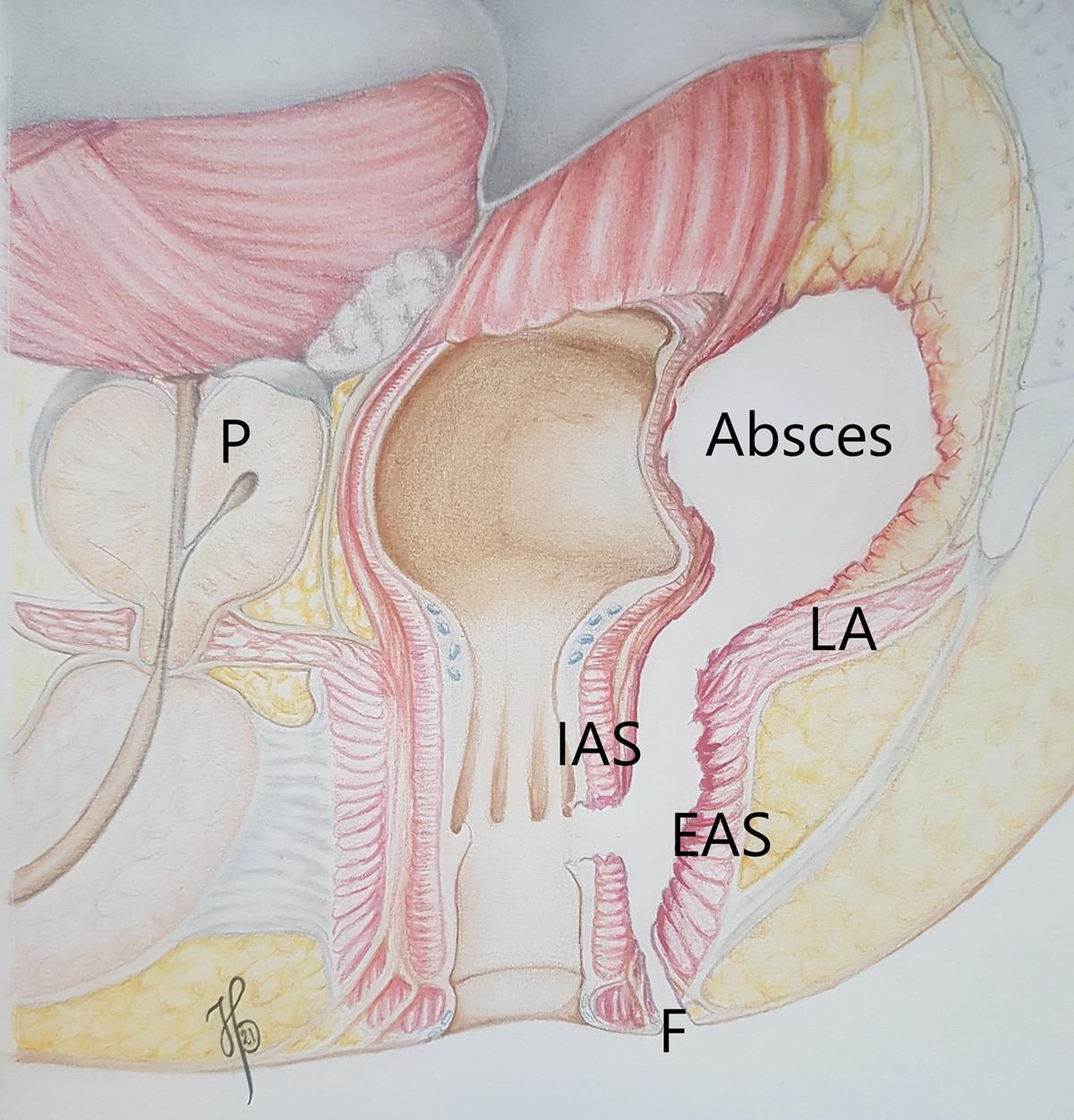 Sagittalsnit af absceslokalisation. EAS = eksterne analsphinkter; F = fistel; IAS = interne analsphinkter; LA = levator ani; P = prostata.