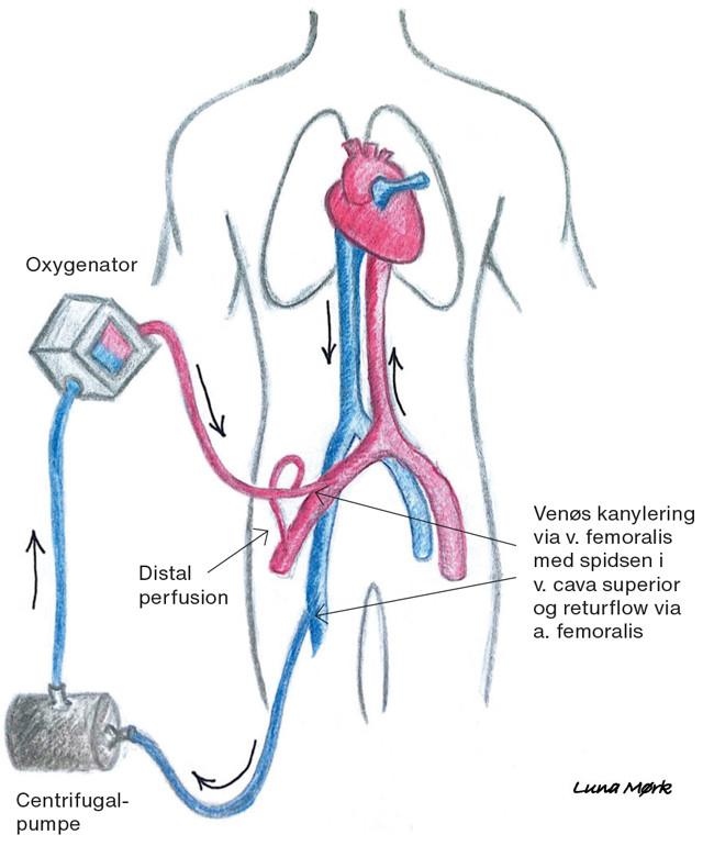Veno-arteriel ekstrakorporal membranoxygenering. Blodet pumpes fra det venøse kredsløb via v. femoralis igennem en ­oxygenator, som fjerner CO2 og tilfører O2, hvorefter blodet pumpes tilbage til det arterielle kredsløb via a. femoralis ­retrogradt i aorta descendens. Illustration: Luna Mørk
