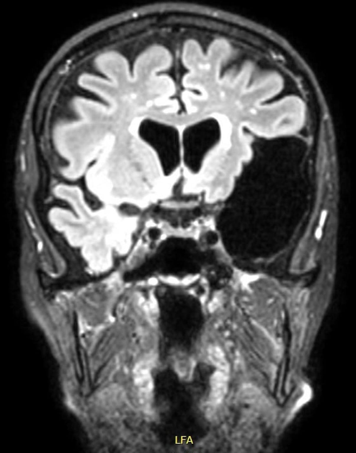 MR-skanningsbillede af stor arachnoideacyste i venstre temporal­region.