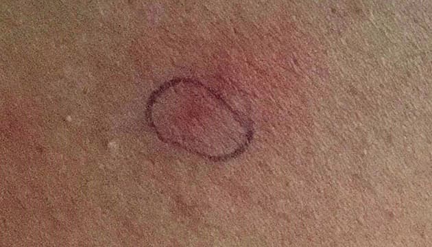 Diskret hudblødning med omkringliggende urticaria fra patientens ryg.