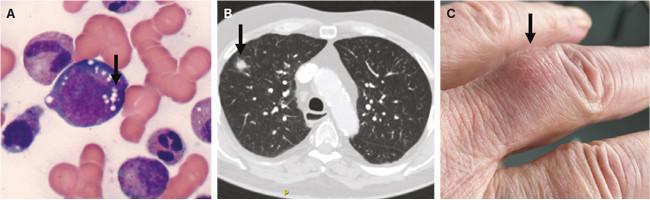 A. Udstrygningspræparat af knoglemarv fra patient med VEXAS, hvor de klassiske cyto­plasmatiske vakuoler i en myeloid progenitorcelle kan ses (pil). Præparatet er farvet med May-Grünwalds eosinmetylenblå farvning. B. CT af lungerne hos en patient med VEXAS med uspecifik infiltrativ forandring i højre lunge (pil). C. Kutan nodulær forandring typisk for patienter med VEXAS (her lokaliseret på tredje venstre finger) (pil).