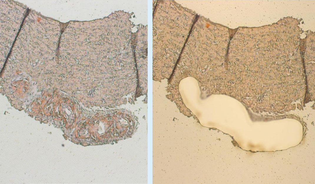 Myokardiebiopsi før og efter laserdissektion af område med amyloid substans.