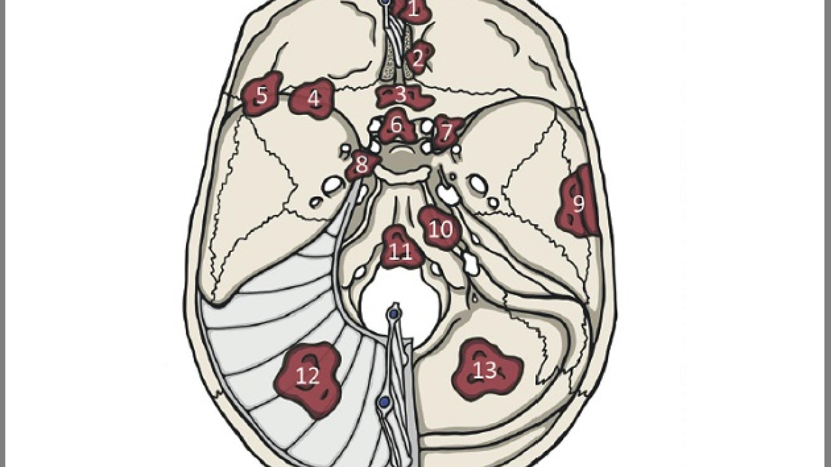© Ugeskrift for Læger / Typiske placeringer af intrakraniale meningeomer.