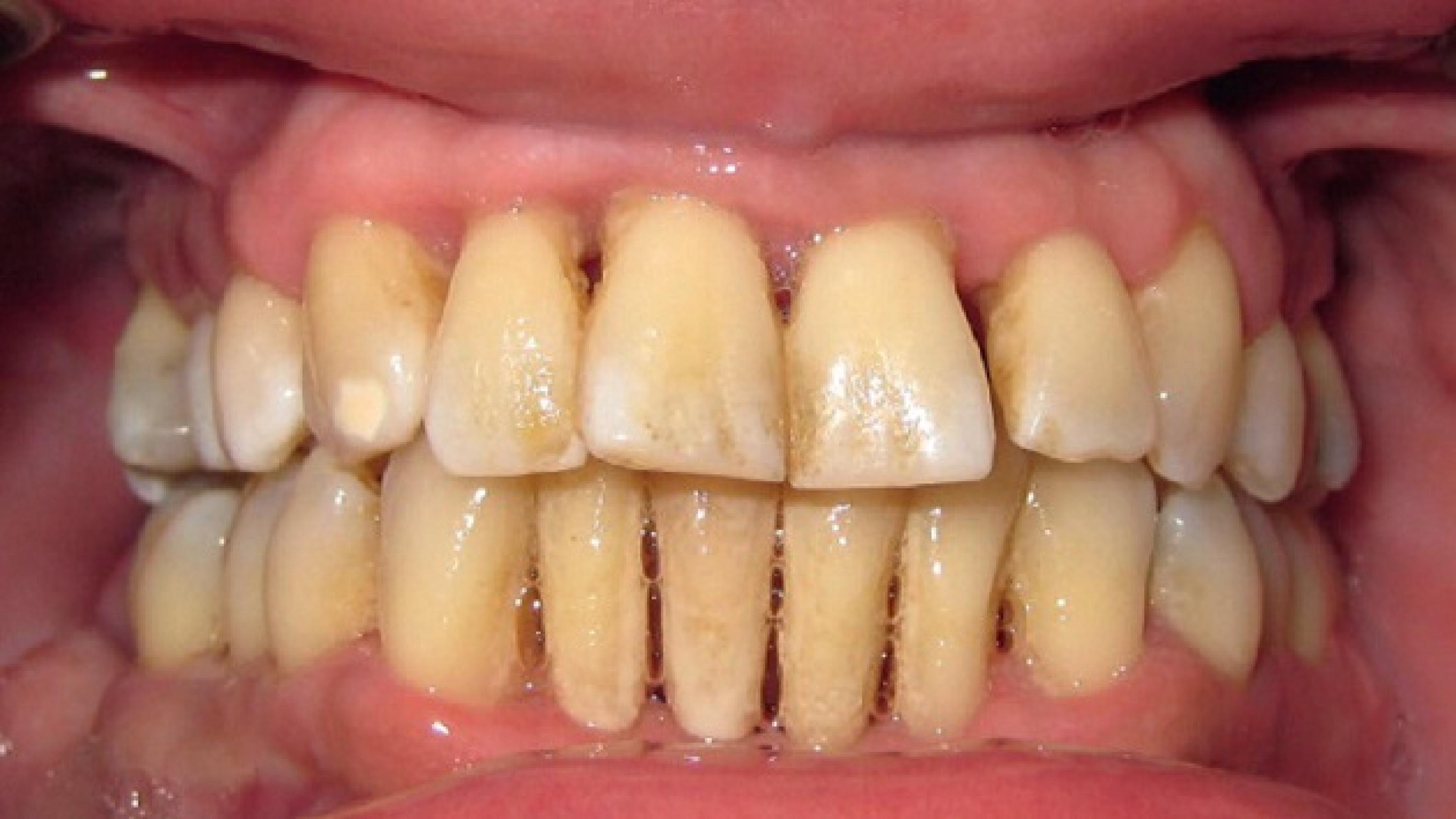 ©. Parodontitis med pus, plak og tandsten samt store gingivale retraktioner.