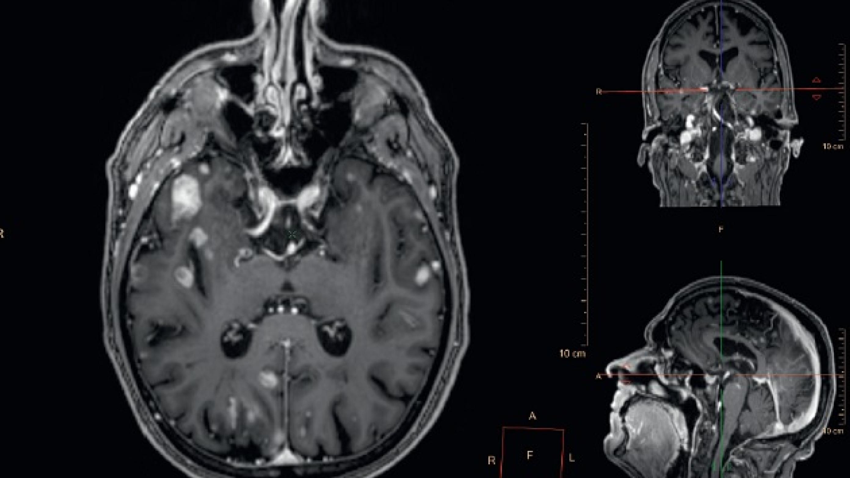 © MR-skanningsbilleder af hjernemetastaser fra et melanom.
