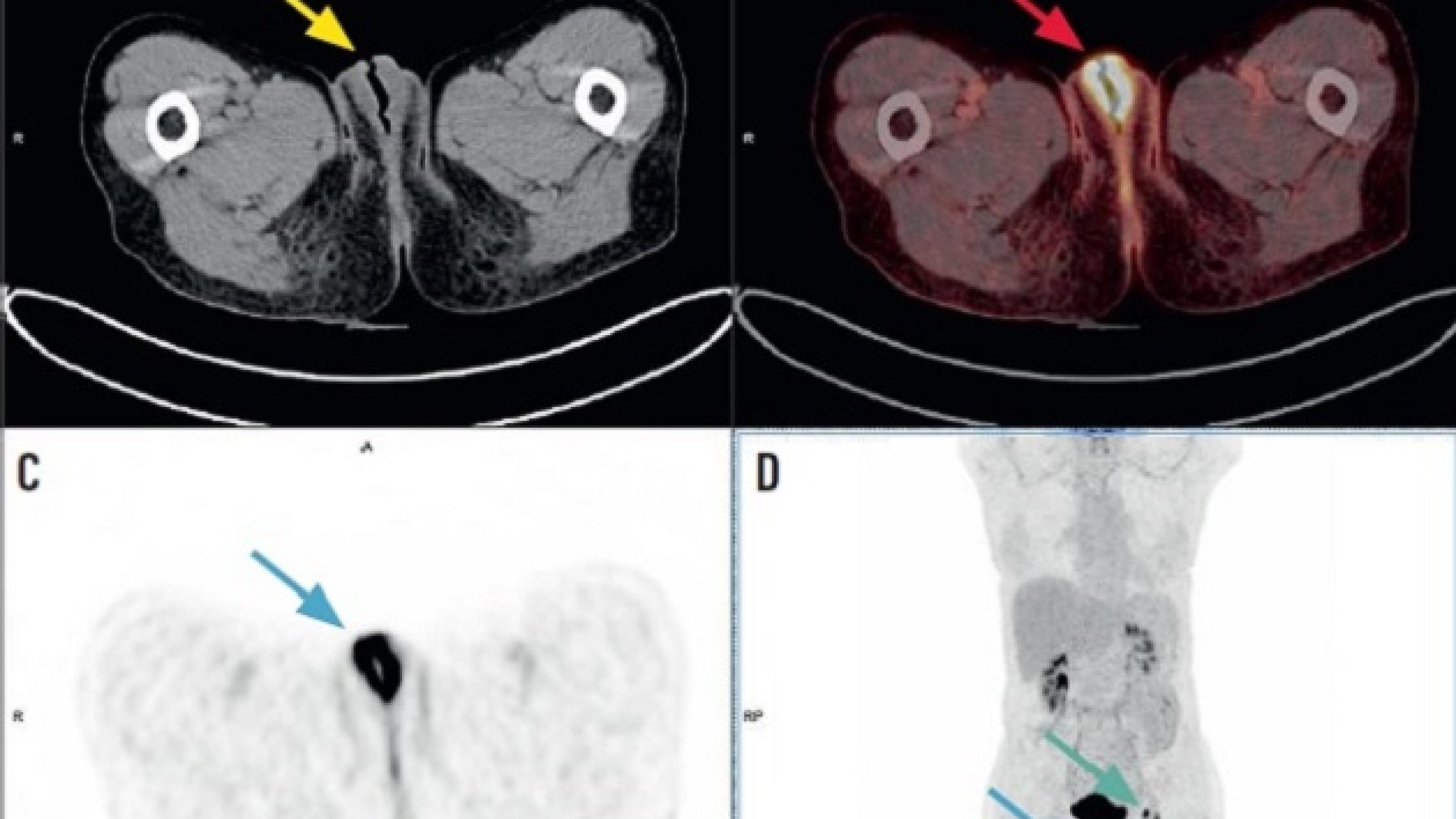 © 18F-fluordeoxyglucose. PET/CT-billeder af kontrastopladende vulvatumor med metastasesuspekte lymfeknuder i venstre inguen.