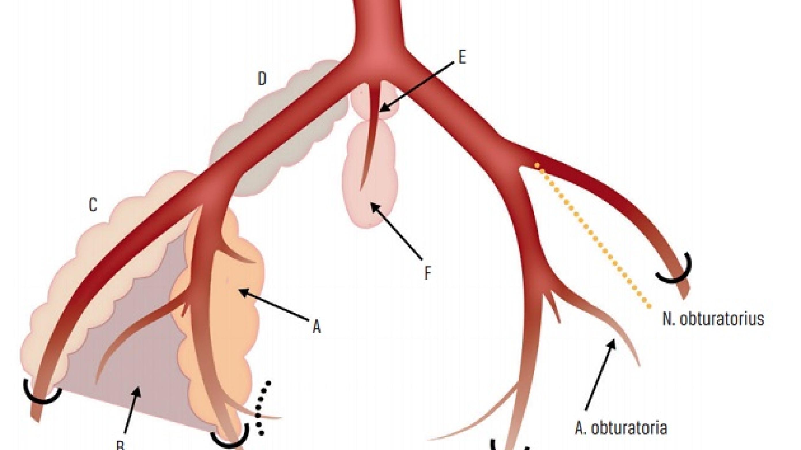 De laterale bækkenlymfeknudekompartmenters anatomi. Illustration: Thomas Balle