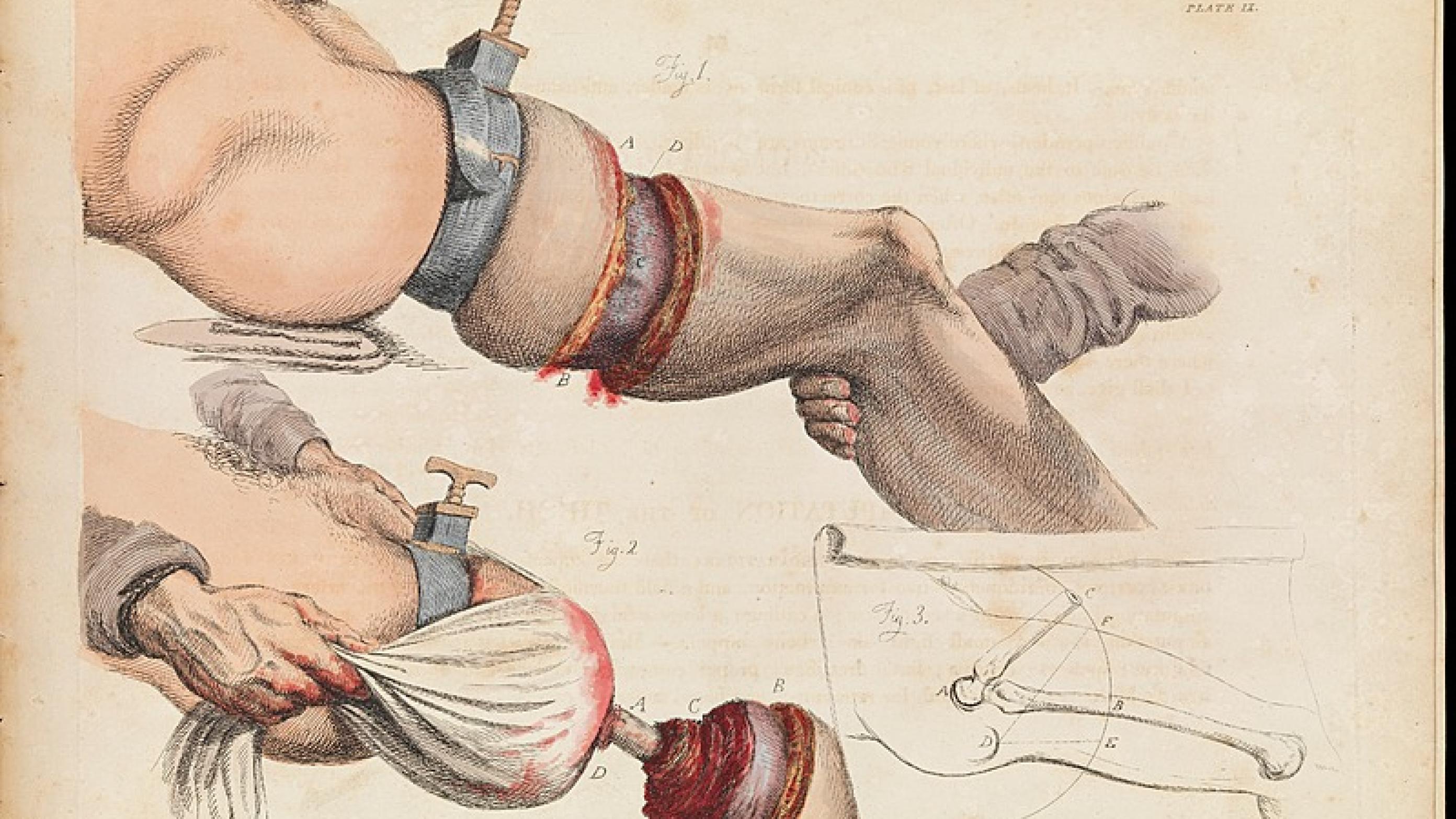 Kirurgiens største fremskridt i 1800-tallet var æterbedøvelsen, som havde debut i 1846. Den kirurgiske planche er fra årene før og viser en låramputation med anvendelse af tourniquet. (Wellcome Collection)