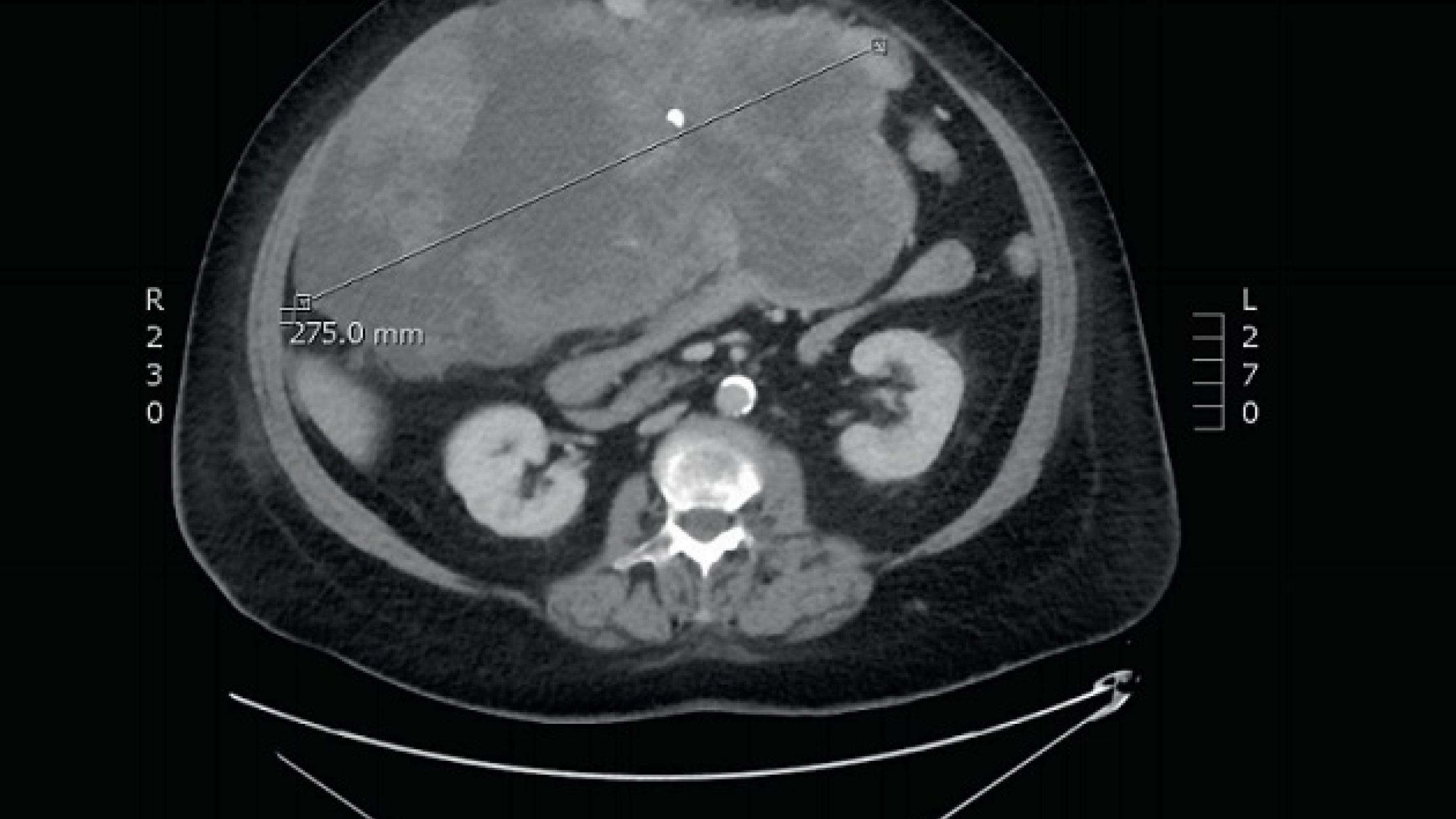 CT-billede af en stor tumormasse i abdomen. ©