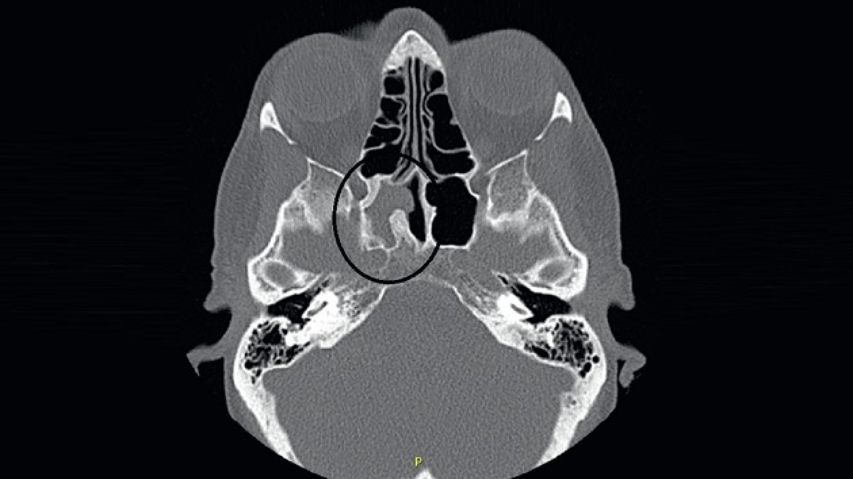 CT af bihuler, hvor der ses let fortykket slimhinde i sinus sphenoidalis dxt. som følge af kronisk sinuitis