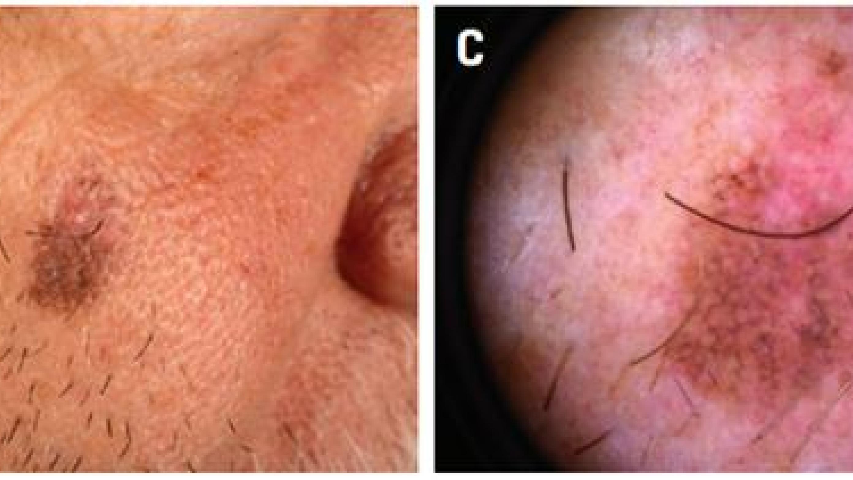 Vekslende pigmenteret tumor (10 × 7 mm) på højre kind hos en 73-årig mand. 