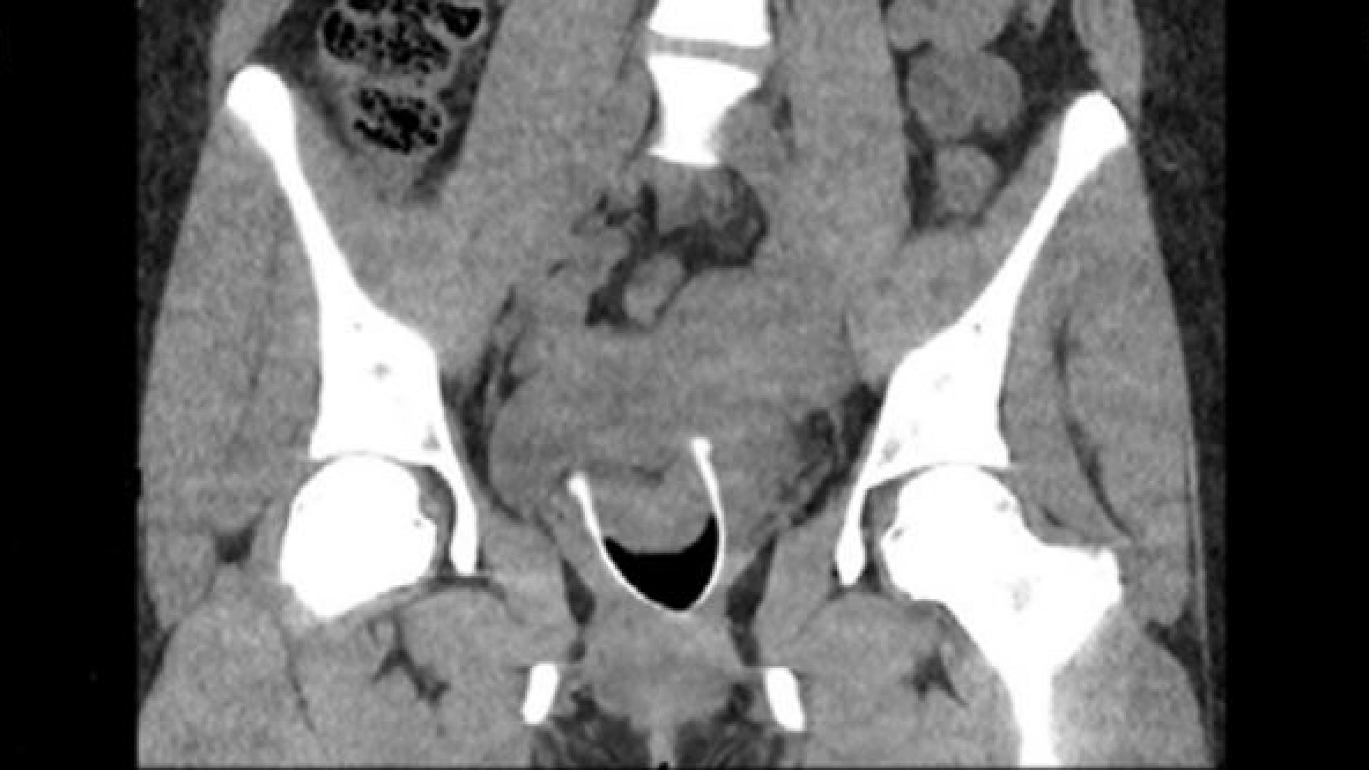 CT-urografi. Der ses højresidig hydronefrose samt en cystisk proces i milten. Endvidere ses et fremmedlegeme i vagina.