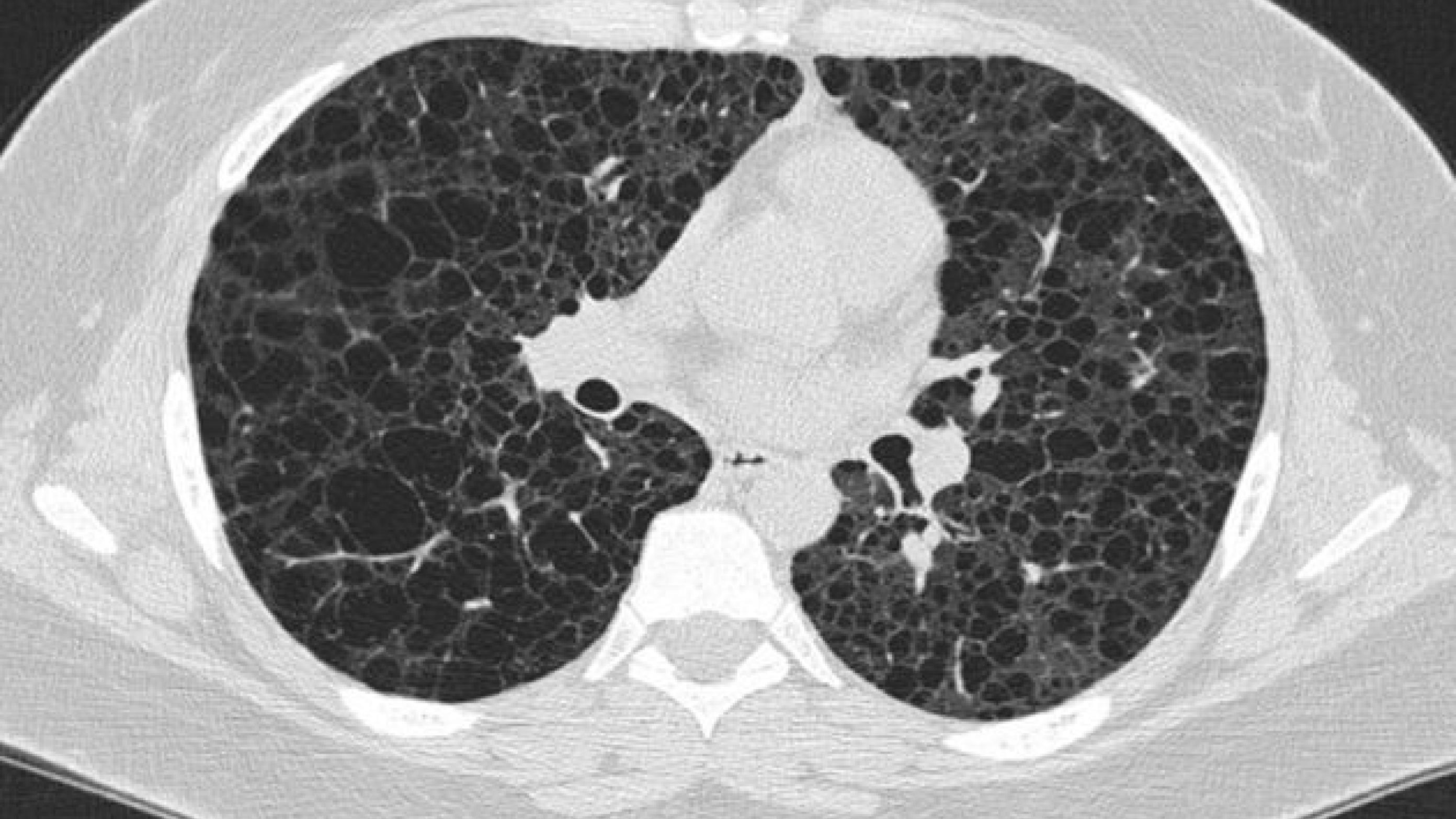High-resolution computed tomography af lungerne hos en patient med tuberøs sklerose-kompleks og lymfangioleiomyomatose.