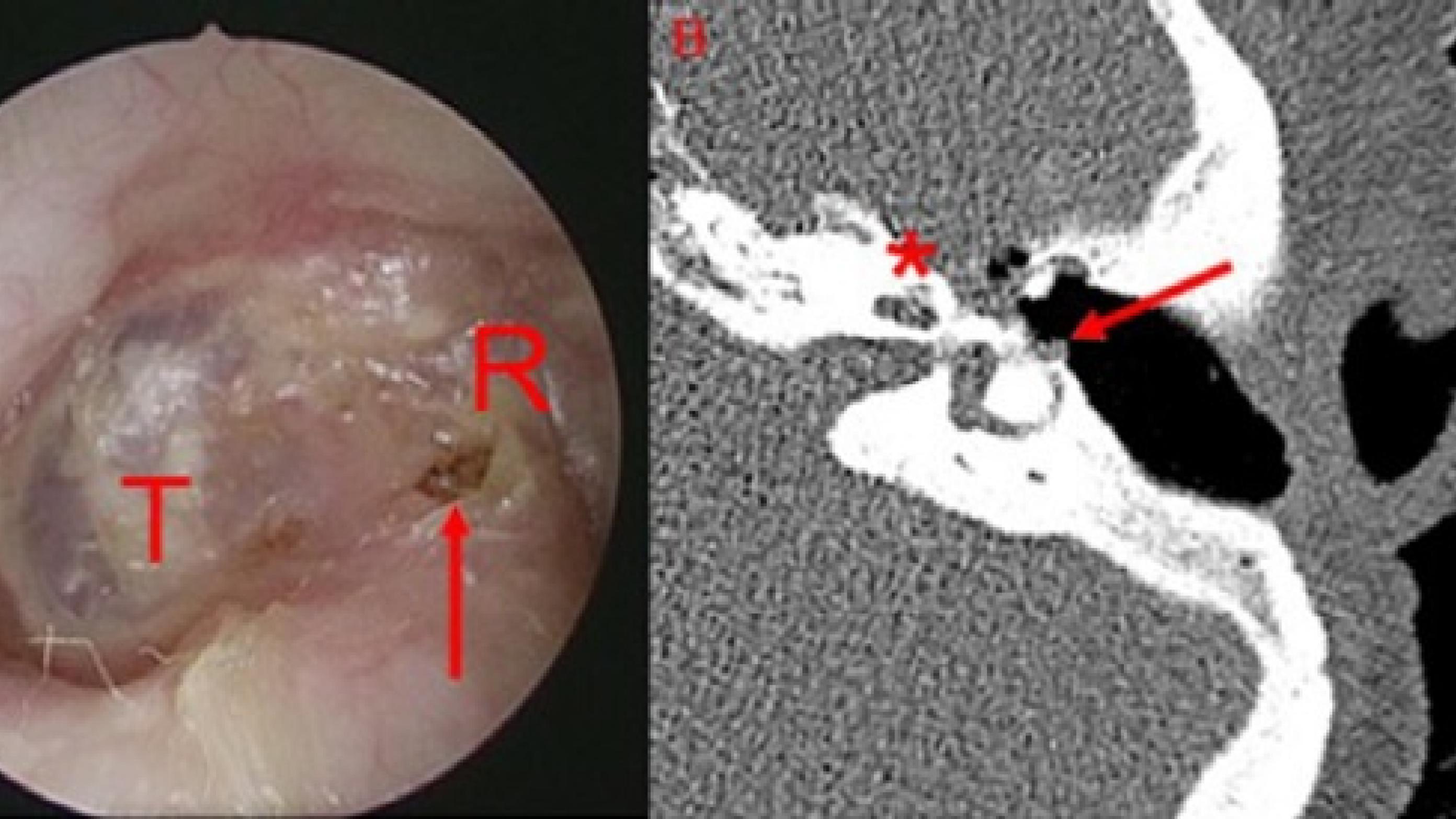 A. En trommehinde med følger efter tidligere kirurgi (T), forreste del af radikalkavitet (R) og skorpedannelse over den laterale buegang (pil). B. Manglende knogledække over den laterale buegang (pil), cochlea (*).