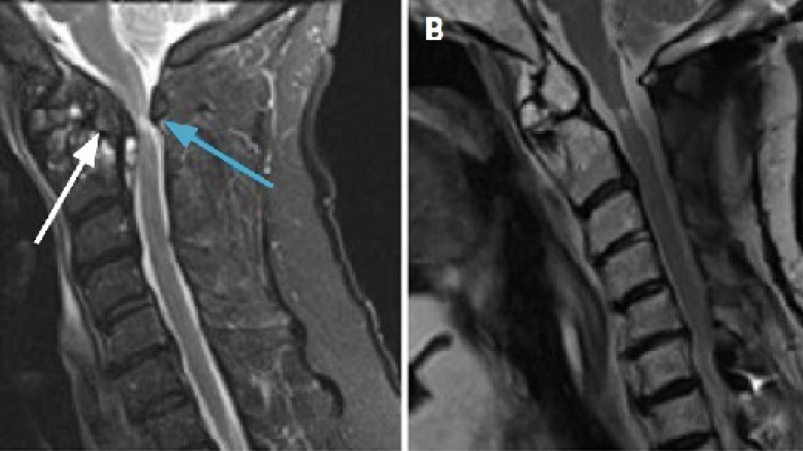 A. MR-skanning af columna cervicalis. B. MR-skanning af columna cervicalis et år postoperativt. 