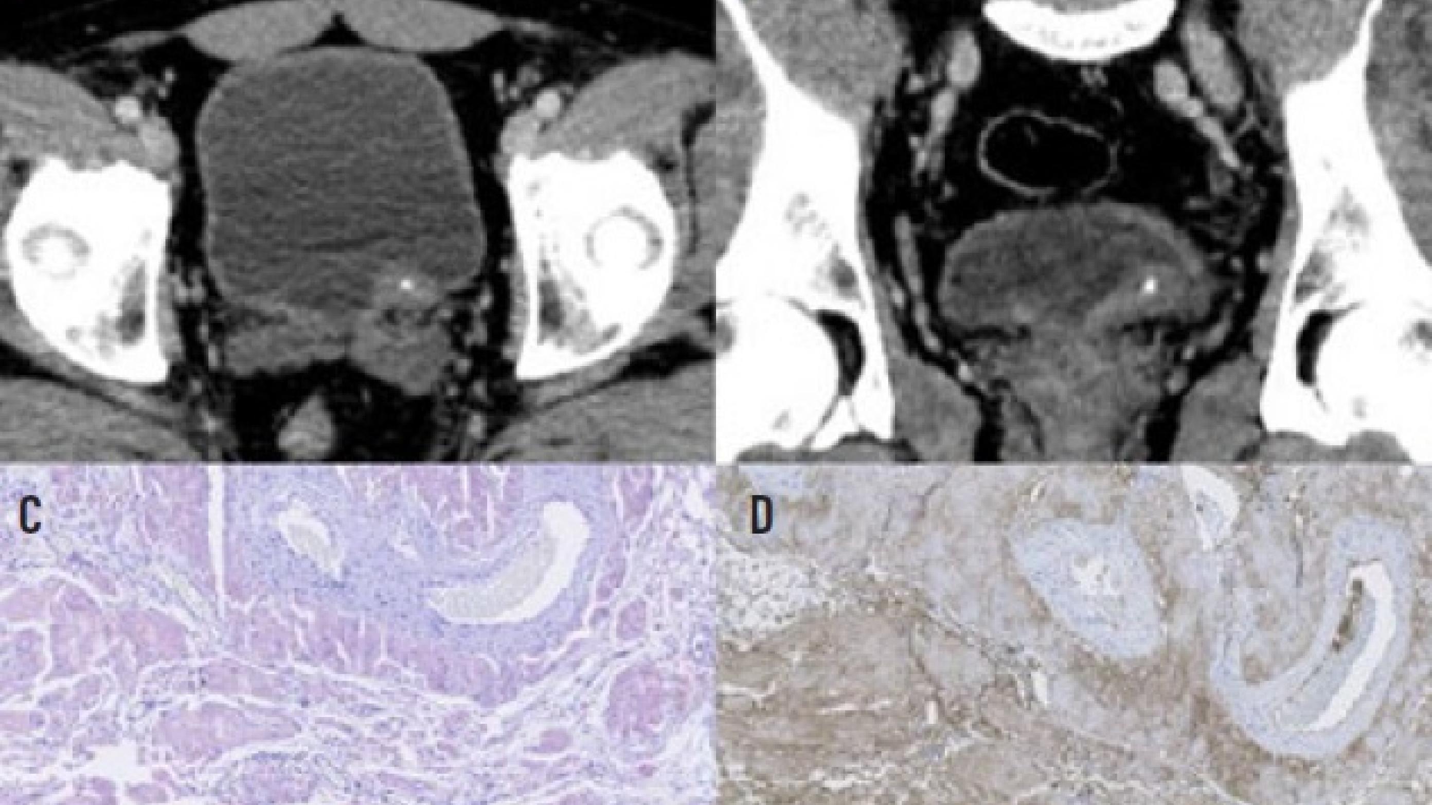 Abdomen med kontrast viser en tumor i distale venstre ureter med central forkalkning