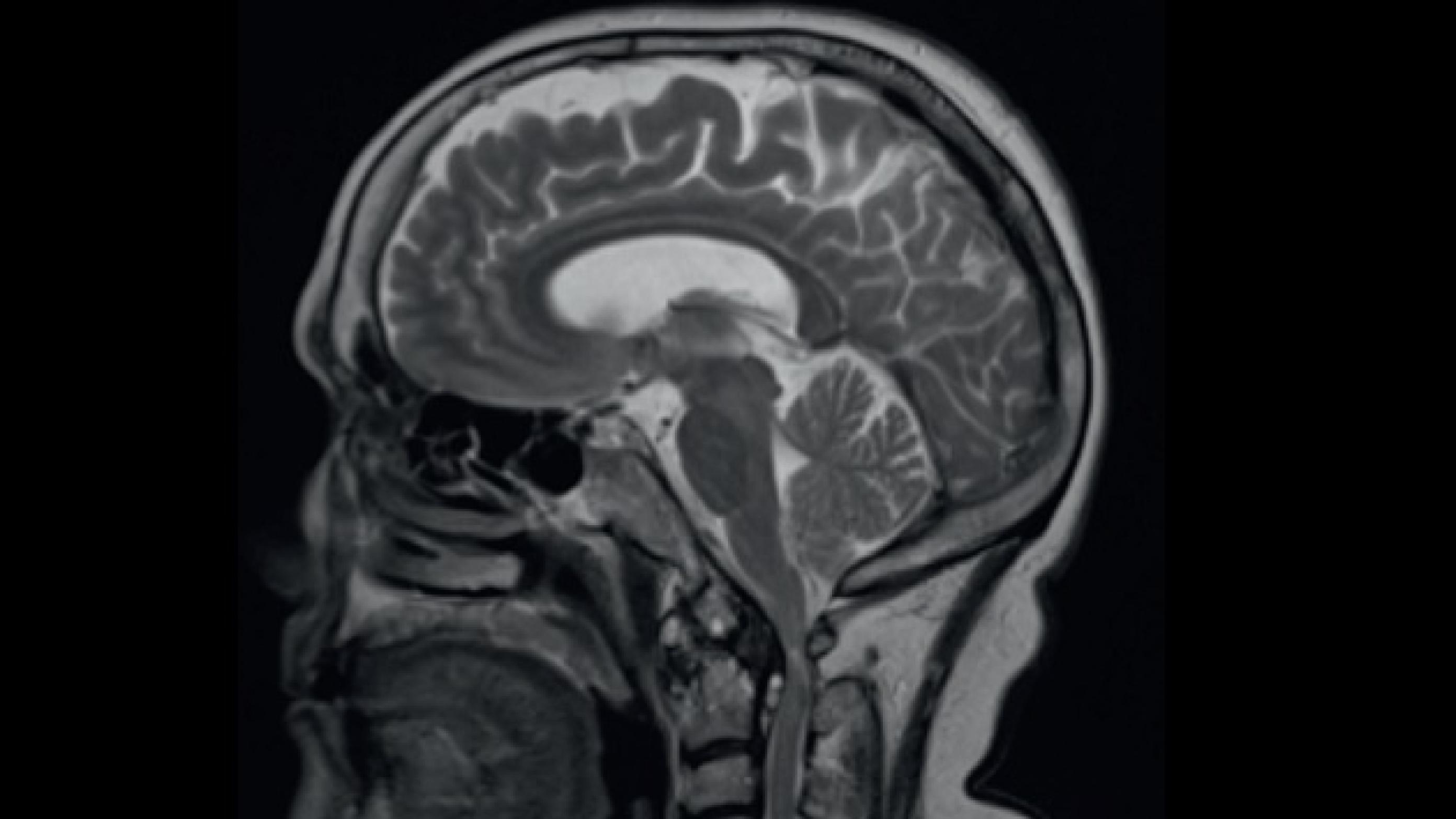 MR-skanningsbillede af cerebrum.